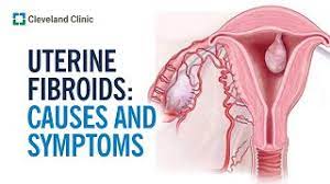 Cures for Fibroids